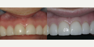 Porcelain Veneers before and after photo