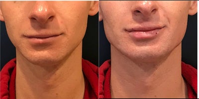 Restylane before and after photo