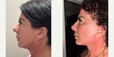 Facelift before and after photo