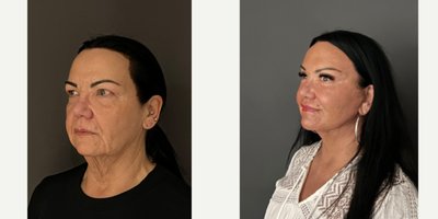 Neck Lift before and after photo