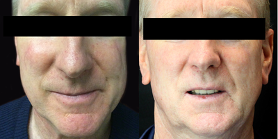 Sclerotherapy before and after photo
