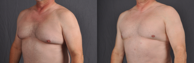 Smart Lipo before and after photo