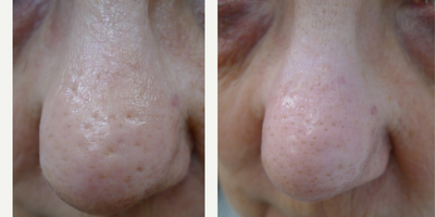 TCA Peel before and after photo