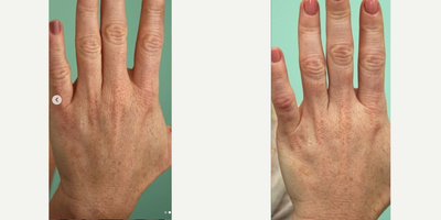 Juvederm before and after photo