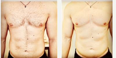 Laser Hair Removal before and after photo