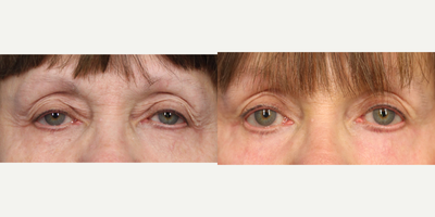 Laser Resurfacing before and after photo