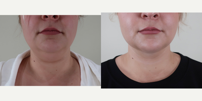 Nonsurgical Neck Lift before and after photo