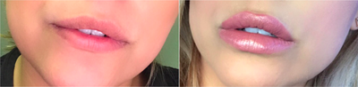 Restylane before and after photo