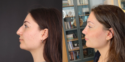 Rhinoplasty before and after photo