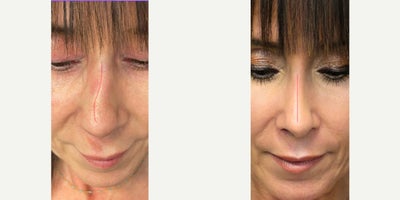Rhinoplasty before and after photo