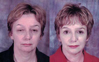 Eyelid Surgery before and after photo
