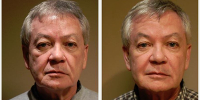 Liquid Facelift before and after photo