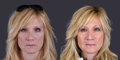 before and after image
