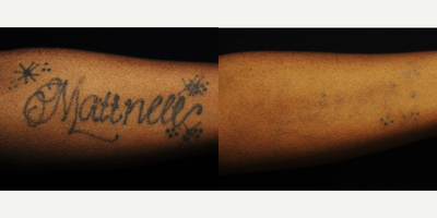 Tattoo Removal before and after photo