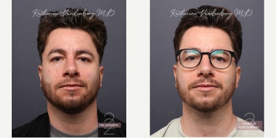 Chin Liposuction before and after photo