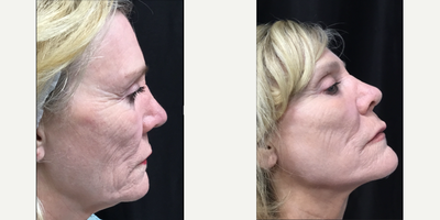 CO2 Laser before and after photo