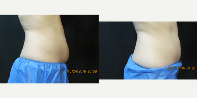 CoolSculpting before and after photo