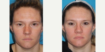 Rhinoplasty before and after photo