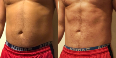 Emsculpt before and after photo