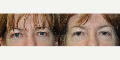 Eyelid Surgery before and after photo