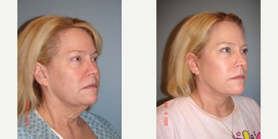 Facelift before and after photo