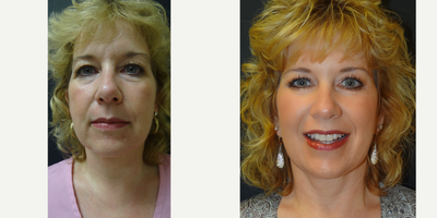Fraxel Laser before and after photo