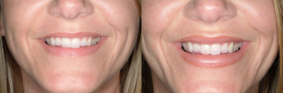 Lip Implants before and after photo