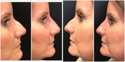 Voluma before and after photo