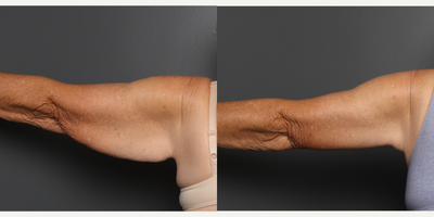 Arm Lift before and after photo