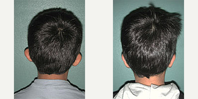 Ear Surgery before and after photo
