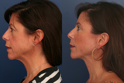 Facelift before and after photo