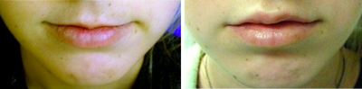 Restylane before and after photo