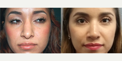 Rhinoplasty before and after photo