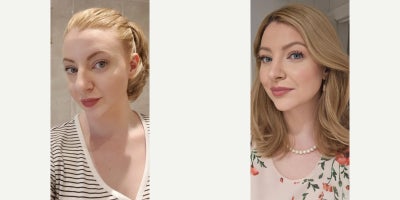 Rhinoplasty before and after photo