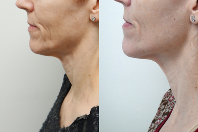 Ultherapy before and after photo