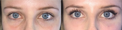 Dermal Fillers before and after photo