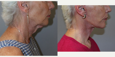 Facelift before and after photo