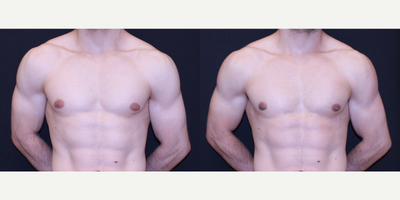 Gynecomastia Surgery before and after photo
