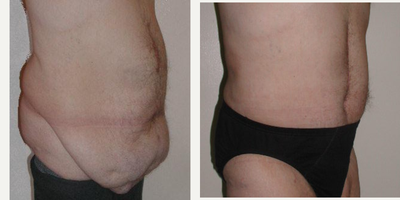Male Tummy Tuck before and after photo