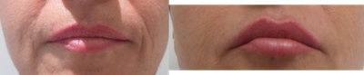 Restylane Silk before and after photo