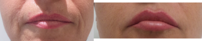 Restylane Silk before and after photo