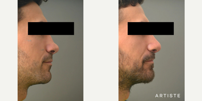 Revision Rhinoplasty before and after photo