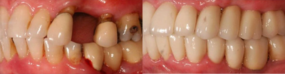 Dental Implants before and after photo