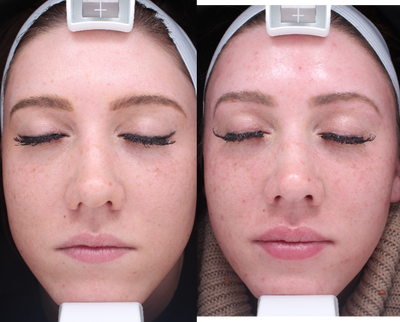 Dermal Fillers before and after photo