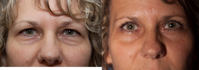 Eyelid Surgery before and after photo