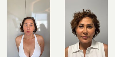 Facelift before and after photo