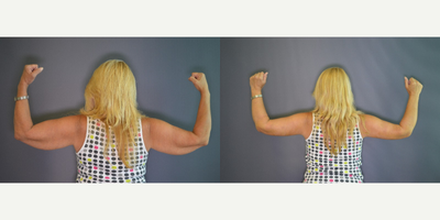 Arm Lift before and after photo