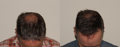 FUE Hair Transplant before and after photo