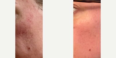 IPL before and after photo