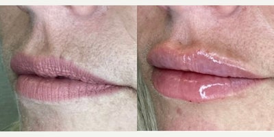 Lip Fillers before and after photo
